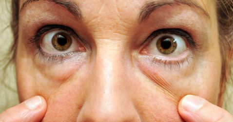 Comment se débarrasser rapidement des yeux gonflés: 5 moyens
